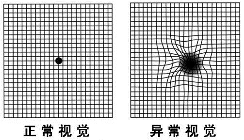 黄斑病变自我检测表-2